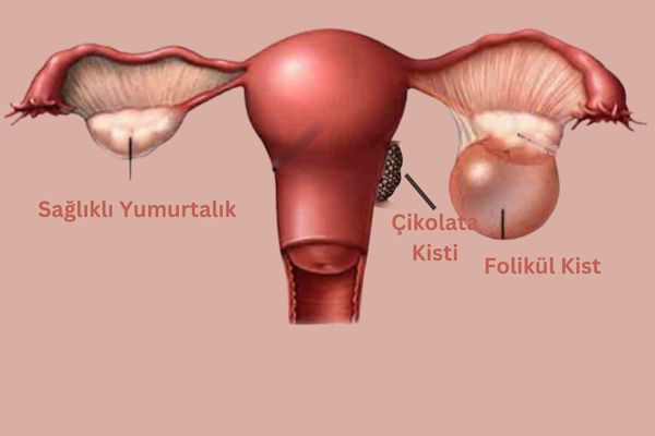 Yumurtalık kistleri gebe kalmayı engeller mi? Antalya